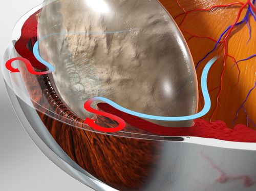 Thumbnail image for "Glaucoma (Angle Closure Type)"