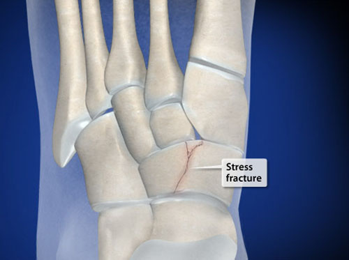 Video Navicular Stress Fracture Healthclips Online