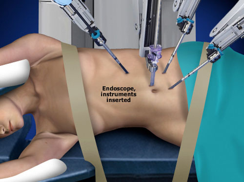 Thumbnail image for "da Vinci® Nephrectomy"