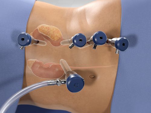 Thumbnail image for "Radical Nephrectomy (Robot-Assisted)"