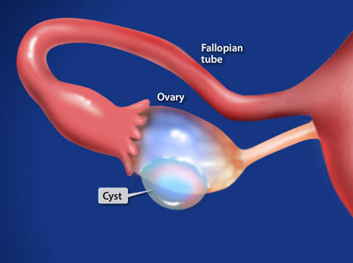 Thumbnail image for "Cistectomía ovárica (Laparoscópica)"