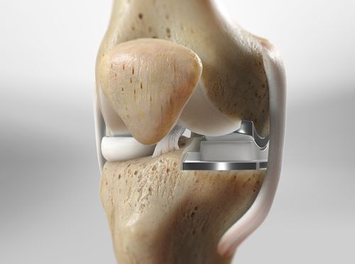 Thumbnail image for "Partial Knee Replacement (With Oxford® Implant)"