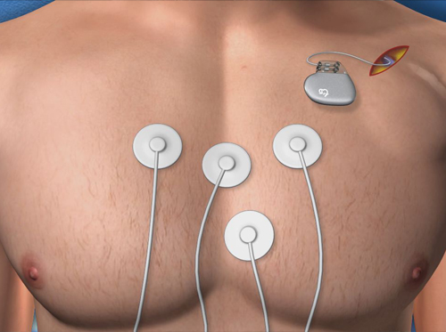 Thumbnail image for "Implante de marcapasos (abordaje endocárdico)"