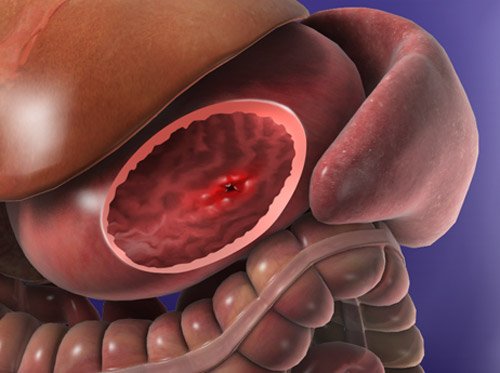 Thumbnail image for "Peptic Ulcer"