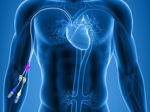 Thumbnail image for "PICC Line (Peripherally-Inserted Central Catheter)"