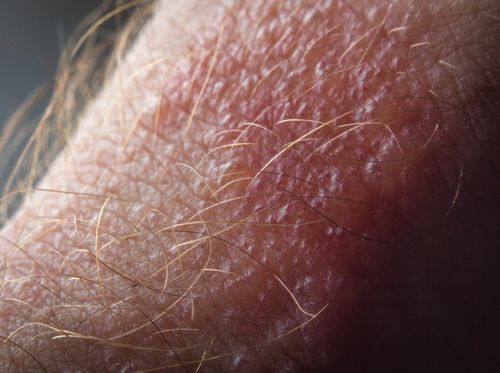 Thumbnail image for "Reacción a la hiedra, roble y zumaque venenosos (dermatitis por contacto inducida por urushiol)"