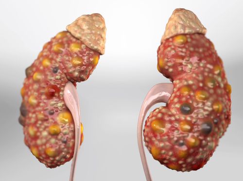 Thumbnail image for "Enfermedad renal poliquística"