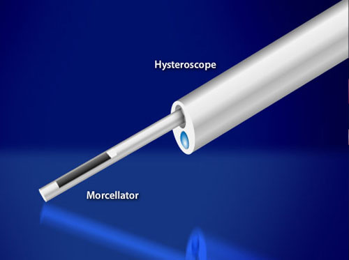 Thumbnail image for "Polypectomy (Hysteroscopic Morcellator)"
