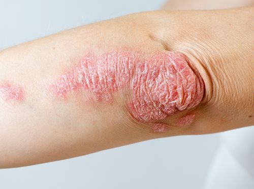Thumbnail image for "Psoriasis"