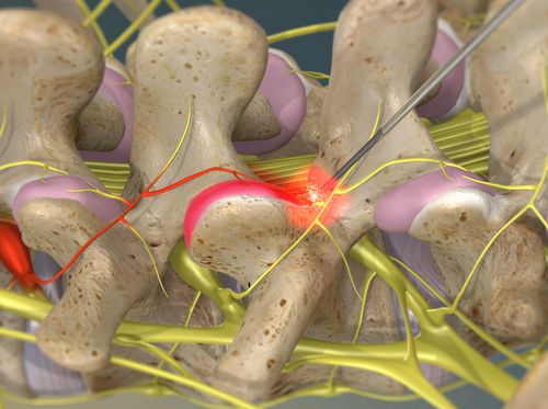 Video Neurotomía por radiofrecuencia en las facetas lumbares