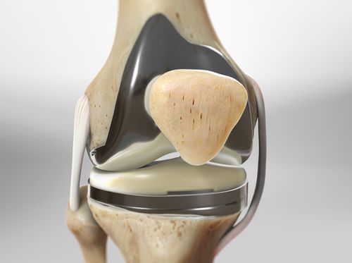 Thumbnail image for "Revision Total Knee Replacement"