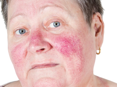 Thumbnail image for "Rosacea"