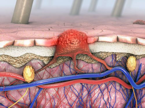 Thumbnail image for "Skin Cancer"