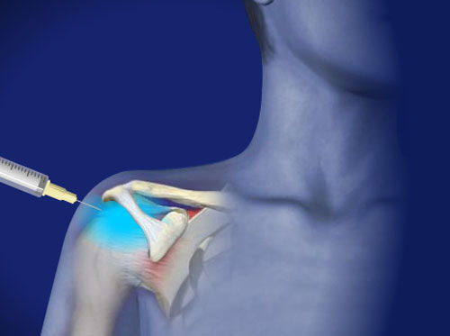 Video Steroid Injection For Shoulder Bursitis Healthclips Online