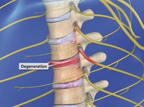 Video - Spinal Stenosis (Thoracic) - HealthClips Online