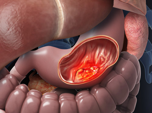 Thumbnail image for "Stomach (Gastric) Cancer"