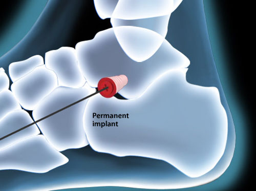 Video - Subtalar Implant for Adult Acquired Flatfoot - HealthClips Online