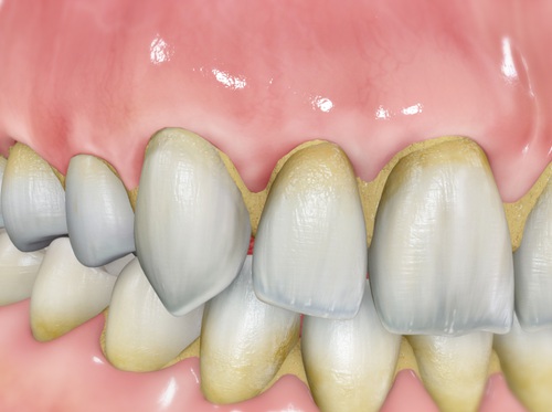 Thumbnail image for "Sarro (cálculo dental)"