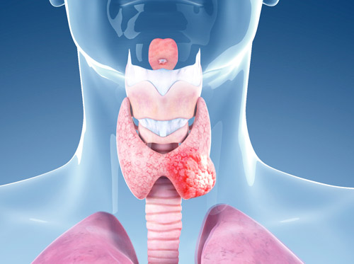 Thumbnail image for "Cáncer de tiroides"