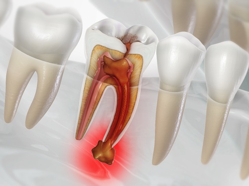 Thumbnail image for "Absceso dental"