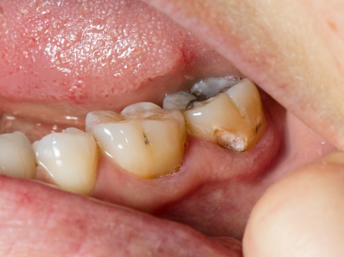 Thumbnail image for "Caries dental"