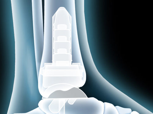 Video On Ankle Joint Replacement