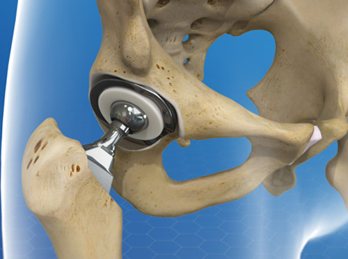 Total Hip Replacement Surgery Video