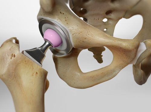 Thumbnail image for "Total Hip Replacement"