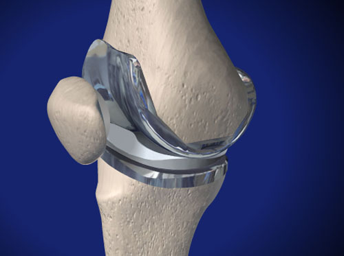 Total Hip Replacement (Minimally-Invasive Method, Two Incisions)