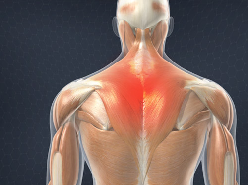 Video - Muscle Strain of the Upper Back (Trapezius Strain)