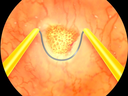 Video Transurethral Resection Of Bladder Tumor TUR Or TURBT