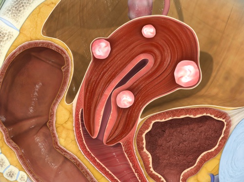 Thumbnail image for "Uterine Fibroids"
