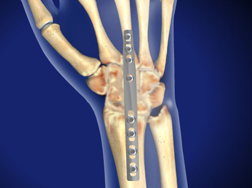 Video Fusi n De Mu eca Artrodesis Total De Mu eca HealthClips Online Video Fusi n De Mu eca Artrodesis Total De Mu eca HealthClips Online
