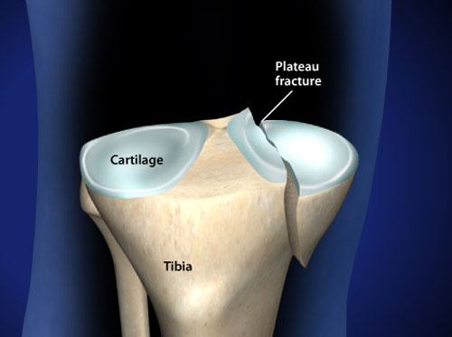 Video - Tibial Plateau Fracture - HealthClips Online