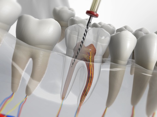 Thumbnail image for "Root Canal (Endodontic Treatment)"