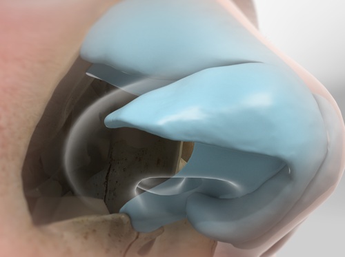 Thumbnail image for "Septoplasty"