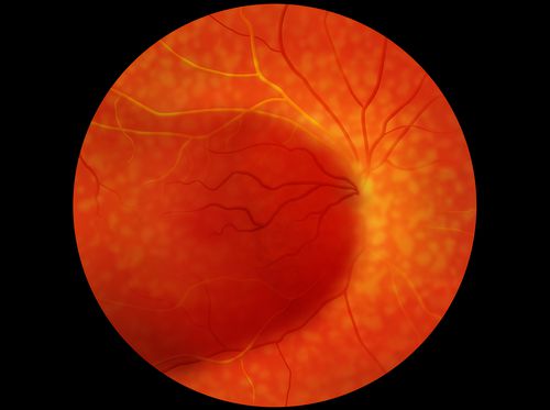 Video - Diabetic Retinopathy - HealthClips Online