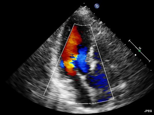 Video - Echocardiogram - HealthClips Online