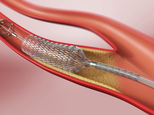 Thumbnail image for "Carotid Angioplasty and Stenting"