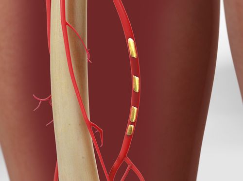 Thumbnail image for "Peripheral Artery Angioplasty and Stenting"