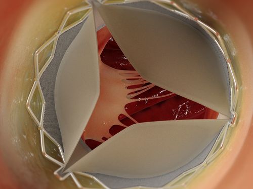 Thumbnail image for "Transcatheter Aortic Valve Replacement (TAVR; TAVI)"